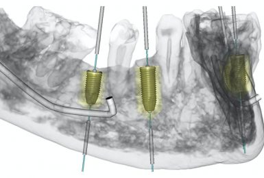 dental-implant-procedure