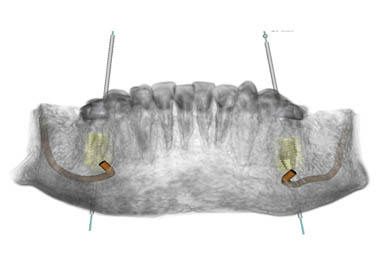 dental-implants-london
