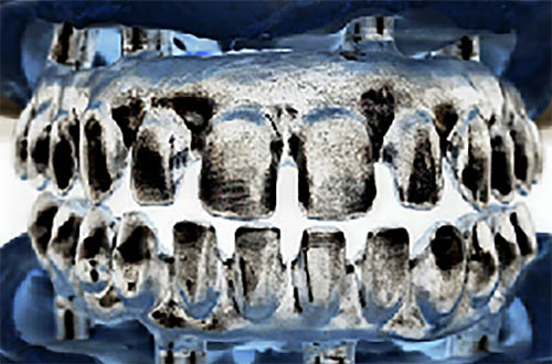 empty-space-between-the-teeth