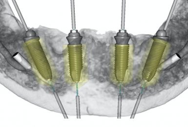 immediate-loading-implants