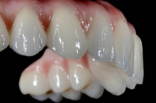 loss-of-natural-teeth
