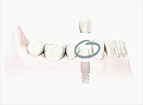 medical-dental-implants