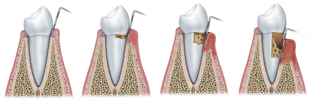 periodontal-disease-treatment
