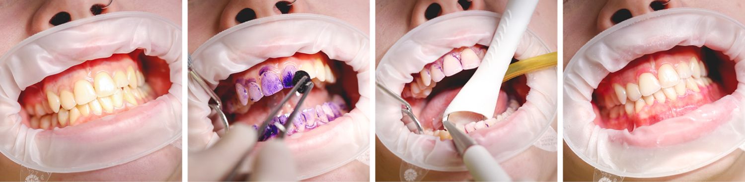 Uklanjanje-biofilma-zubi-GBT protokol
