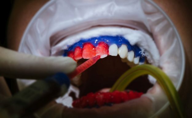 izbjeljivanje zubi rijeka jelusic izbjeljivanje zubi rijeka jelusic