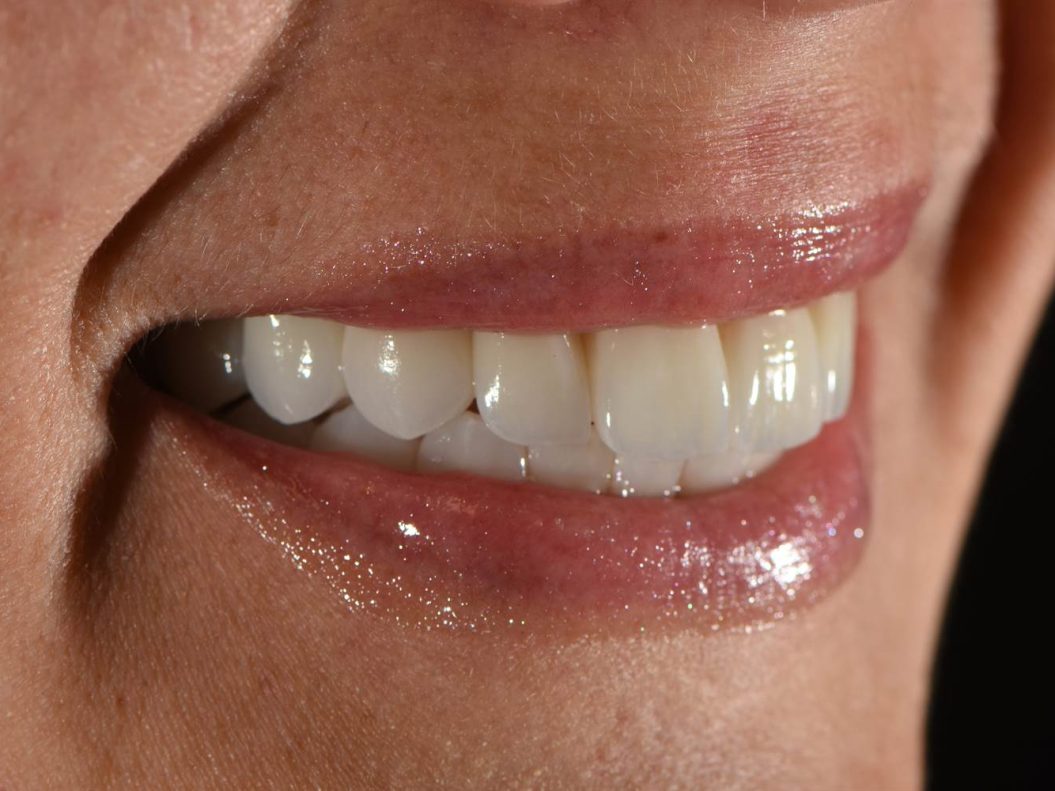 implantati allon4