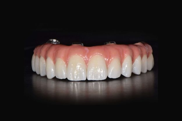 All-on-4 Nobel – Jelusic-1 al